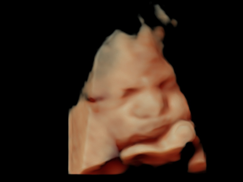 ¿Qué es la hidronefrosis en recién nacidos? La hidronefrosis en recién nacidos es un agrandamiento o dilatación de la pelvis renal, el embudo en la parte central del riñón donde se acumula la orina. La hidronefrosis puede ocurrir en uno o en ambos riñones. Esta afección a menudo se diagnostica antes del nacimiento, durante una ecografía prenatal. En algunos casos, la hidronefrosis es leve y desaparece por sí sola sin tratamiento. En otros casos, la hidronefrosis puede ser una señal de un bloqueo en el conducto urinario, o reflujo o acumulación de orina de la vejiga hacia el riñón que necesita tratamiento. El conducto urinario es el sistema de drenaje del cuerpo para eliminar las toxinas y el exceso de líquido. El conducto urinario incluye los riñones, los uréteres, la vejiga y la uretra. Las vías urinarias, que incluyen los riñones, la vejiga, los uréteres y la uretra.El conducto urinario incluye los riñones, los uréteres, la vejiga y la uretra